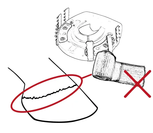 The cast bandage must not cover the coronary band of the hoof.